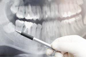 Dentist showing something on dental x-ray image on computer moni