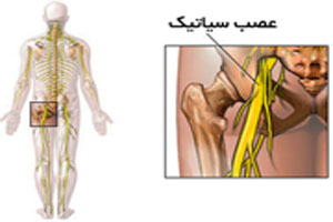 the-most-effective-way-to-treat-sciatica