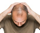 ریزش مو در مردان به چه دلیل است؟