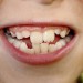 چرا دندان ها کج رشد می کنند؟