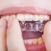 به کمک روشهای خانگی دندان قروچه را درمان کنید..!