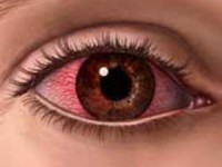 درمان آلرژی های چشمی