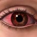 درمان آلرژی های چشمی