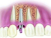 اطلاعاتی درباره ایمپلنت دندان