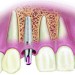 اطلاعاتی درباره ایمپلنت دندان