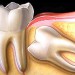 درمان دندان نهفته را به تعویق نیندازید