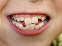 چرا دندان ها کج رشد می کنند؟