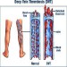 علائم ترومبوز چیست؟