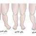 تشخیص و درمان ۳ حالت در پاها