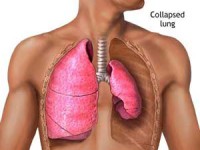 اطلاعاتی درباره بیماری های مزمن انسداد ریه (COPD)