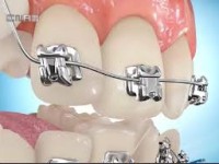 اطلاعات مفید وجامع درباره ارتودنسی دندان ها