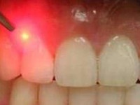 تازه ترین راه حل های درمانی برای پوسیدگی دندان