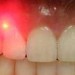 تازه ترین راه حل های درمانی برای پوسیدگی دندان