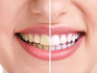 پیشگیری از زرد شدن دندانها