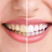 پیشگیری از زرد شدن دندانها