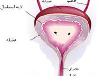 التهاب مثانه در خانمها (سندرم مثانه دردناک)
