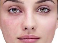 لک‌های پوستی چرا و چطور ظاهر می‌شوند؟