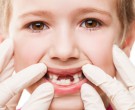 مشکل های رایج رویش دندان های دائمی در کودکان