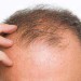 ۶ عامل مهم ریزش مو در آقایان