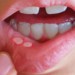 درمان آفت دهان با روش های خانگی و گیاهی