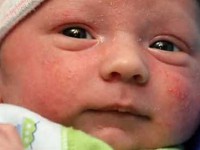 دلیل و درمان جوشهای ریز و سفید صورت نوزاد
