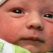 دلیل و درمان جوشهای ریز و سفید صورت نوزاد