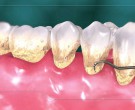 در رابطه با جرم گیری دندان چه می دانید؟