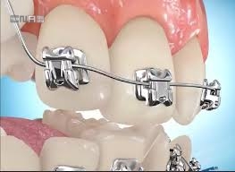 اطلاعات مفید وجامع درباره ارتودنسی دندان ها