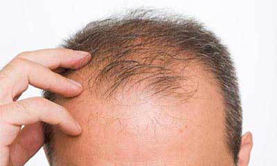 ۶ عامل مهم ریزش مو در آقایان