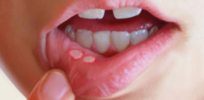 درمان آفت دهان با روش های خانگی و گیاهی