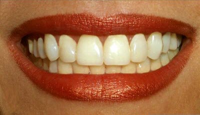 رابطه بین خرابی دندان و مصرف قند