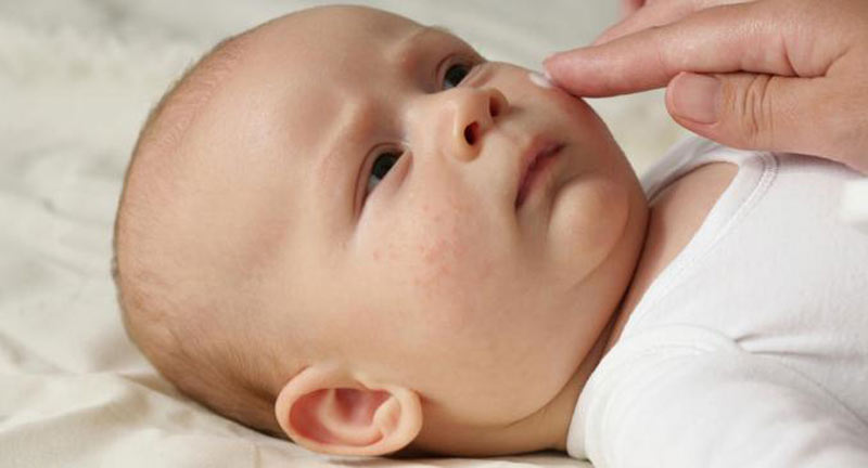 علل و درمان خشکی پوست نوزادان