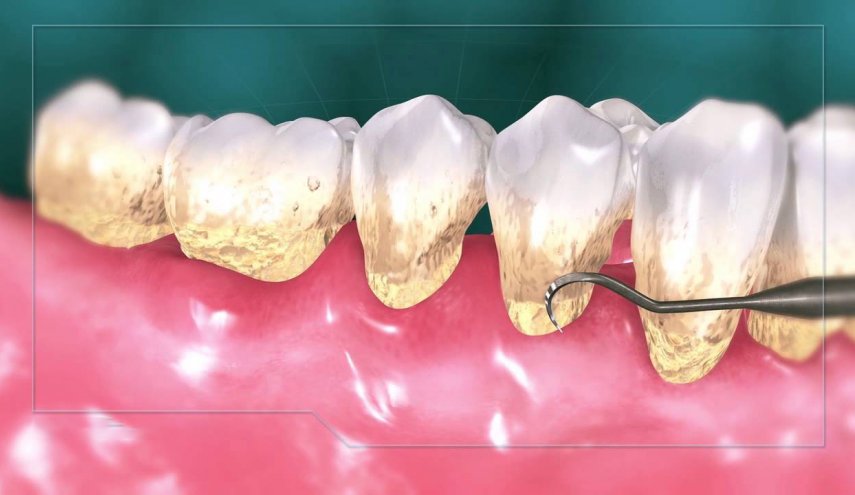در رابطه با جرم گیری دندان چه می دانید؟